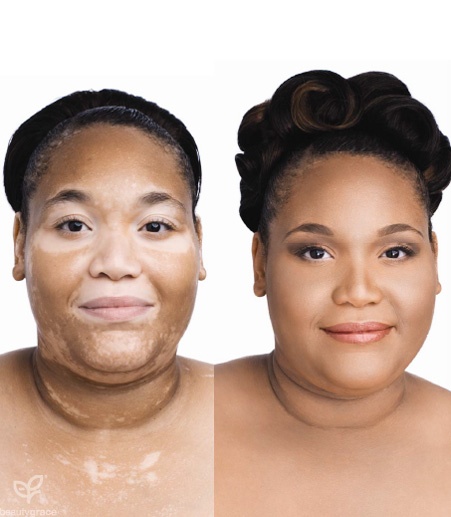 Dicas de maquiagem para vitiligo