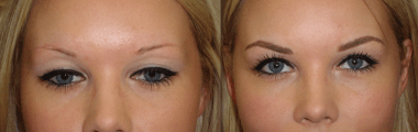 Antes e depois maquiagem definitiva nos olhos