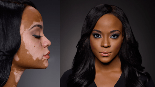 Como cobrir vitiligo com maquiagem passo a passo