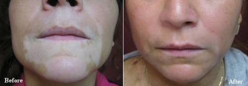 Micropigmentação para vitiligo antes e depois