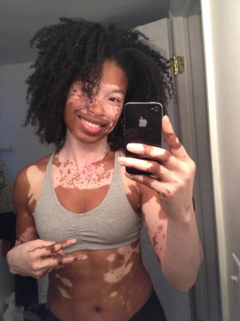 Fotos de mulheres bonitas com vitiligo
